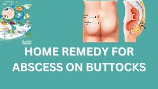 Home remedy for abscess on buttocks  how to get rid of abscess on buttocks [upl. by Aseret17]