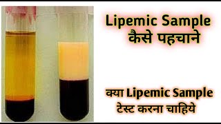 Lipemic blood sample  Lipemic  Lipemic serum [upl. by Reace513]