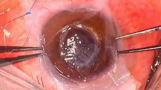 K2EDTA Amniotic Membrane Transplant and ICRS explant for Calcific Keratopathy [upl. by Pacian]