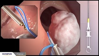 Colonoscopy with polypectomy procedure overview using Olympus devices [upl. by Alleuol]