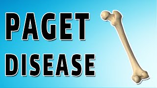 Pagets Disease [upl. by Adierf]