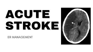 Acute Stroke  ER Management [upl. by Mcclary599]