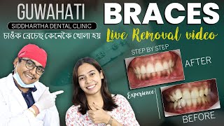 LIVE Braces Removal  Step by step  Best Braces Treatment in Guwahati  Dr Siddhartha Pincha [upl. by Tnomad]