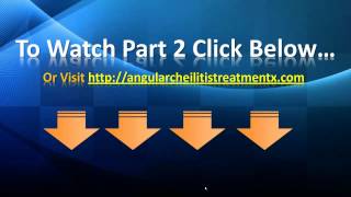 Angular Cheilitis Treatment  Angular Cheilitis Home Remedies [upl. by Engelbert]