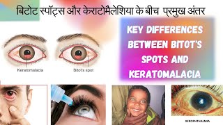 बिटोट स्पॉट्स और केराटोमैलेशिया के बीच अंतरdifferences between Bitots Spots and Keratomalacia [upl. by Rot849]