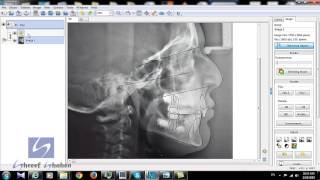 Digital cephalometry superimposition all steps [upl. by Eppillihp449]