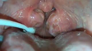 How to remove caseum from your tonsils [upl. by Emylee]