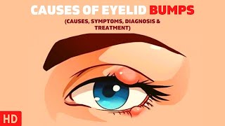 The Surprising Causes of Eyelid Bumps You Never Knew About [upl. by Nongim]