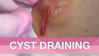 Cyst Draining  Avert your eyes if youre easy queasy [upl. by Enelyt]