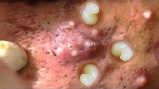 Part 07  Acne Vulgaris and Extracting large Whiteheads [upl. by Wilhelm]