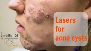 Treating acne cysts [upl. by Morgun]