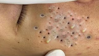 Blackheads amp Whiteheads Satisfying Removal 0284 [upl. by Swithbert135]