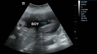 Ultrasound showing boy baby 🤰  23 weeks [upl. by Zeeba]