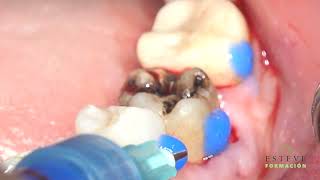 Tooth autotransplantation  Autotransplante Dental 36 [upl. by Retsbew]