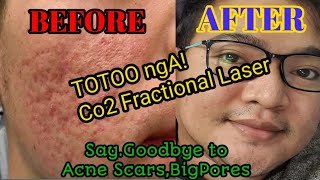 co2 fractional laser  totoo nga sya😍 Honest Review 2021 [upl. by Letsou]