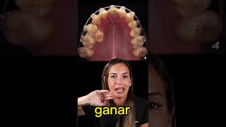 ¡Mira como se mueven los dientes con los brackets ¡Increíble time lapse ortodoncia [upl. by Clellan]