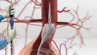 Dr AZENCOTT Anevrisme Aorte Endoprothese Aortique [upl. by Ellga]