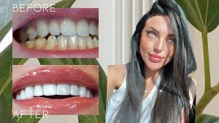 I GOT VENEERS without shaving away any tooth structure [upl. by Aiken]