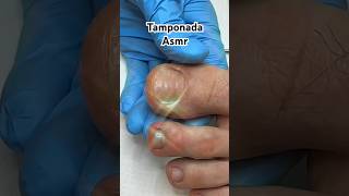 Tamponada✨ podologia asmr [upl. by Jegar344]