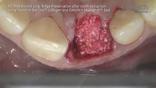 PD PhD Ronald Jung Ridge Preservation after Tooth Extraction using Geistlich Mucograft® Seal [upl. by Lleznod95]