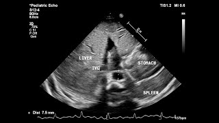 Basic echocardiography심장 초음파 기본 Subcostal view [upl. by Drofkcor]