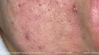 Big Cystic Acne Blackheads Extraction Blackheads amp Milia Whiteheads Removal Pimple Popping [upl. by Eedyak]