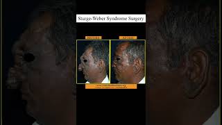 SturgeWeber Syndrome Surgery at GSR [upl. by Refenej]