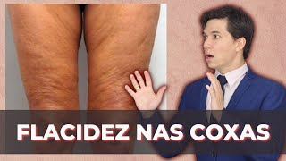 FLACIDEZ DAS COXAS Acabe com a Flacidez do Corpo [upl. by Aivataj]