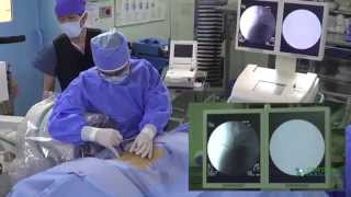 Stem Cell Treatment Degenerative Bulging or Herniated Discs Stop Back Pain [upl. by Orbadiah475]