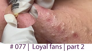 Acne Treatment Huong Da Nang 077  Loyal fans  part 2 [upl. by Avid57]