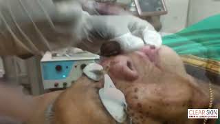 Pyogenic Granuloma Removal by Long Pulse  Enormous Pyogenic Granuloma Removal Treatment amp Excision [upl. by Norb]