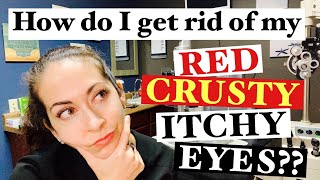 Blepharitis  2 Easy steps to banish red crusty itchy eyes  The Eye Surgeon [upl. by Enybor]