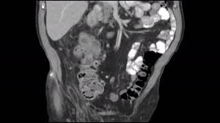 Dedifferentiated liposarcoma mimicking a primary colon mass  CT scan [upl. by Eiramit]