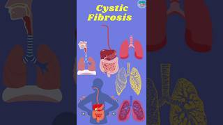 Cystic Fibrosis Mechanism Development Management and Treatment cysticfibrosis cystic [upl. by Shelbi]