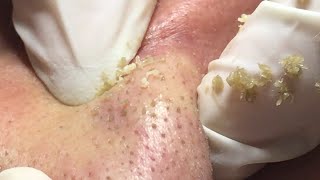 Suri Job 105 EXTRACTION ACNE ON NOSE [upl. by Narra673]