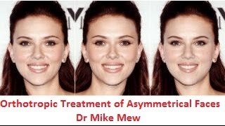 Orthotropics Treatment of Asymmetrical Disproportionate Uneven Faces by Dr MIke Mew [upl. by Halas]