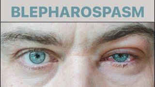 BLEPHAROSPASM  DISEASE OF EYELID [upl. by Namaan]