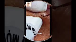 Blackheads Removal  Acne Treatment and Very Satisfying Satisfying Pimple pop blackheads [upl. by Onairotciv]