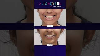 Before and After Aligners Treatment In Hyderabad  Invisible Aligners Journey  Clear Aligners [upl. by Key]