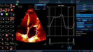 〖Echocardiography〗 Apical 4ChV part I 〖Measurements〗 💫 💟 [upl. by Wehtta]