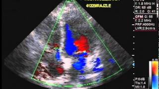 Echocardiography and Color Flow Doppler [upl. by Anah]