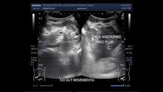 Intestinal obstruction with Perforation [upl. by Ecnirp]