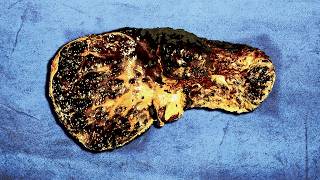 A Family Ate 1 Year Old Frozen Leftovers For Breakfast This Is What Happened To Their Organs [upl. by Atnaloj]