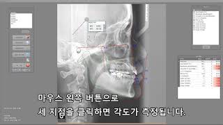 CephStory  직접 길이 각도 측정하기 [upl. by Otes]