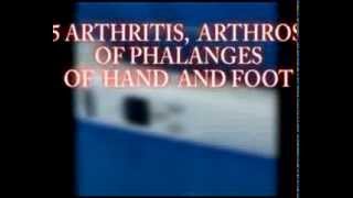 15 ARTHRITIS ARTHROSIS OF PHALANGES OF HAND AND FOOT [upl. by Nottnerb]