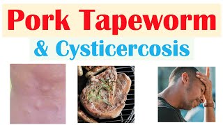 Pork Tapeworm Taeniasis  How It Infects Symptoms amp Cysticercosis Diagnosis Treatment [upl. by Airotal476]