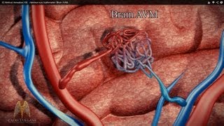 3D Medical Animation HD  Arteriovenous Malformation Brain AVM [upl. by Nolana]