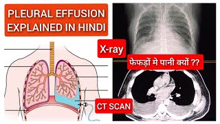 Pleural Effusion  फेफड़ों में क्यों भर जाता है पानी   Pleural Effusion CT Scan Lungs Explained [upl. by Calendre]