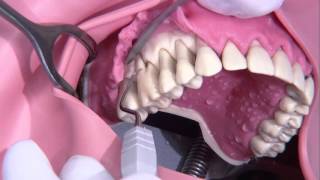 Periodontal surgery Modified Widmann flap [upl. by Zullo420]