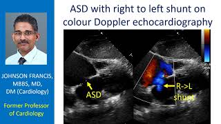 ASD with right to left shunt on colour Doppler echocardiography [upl. by Notxarb]